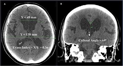 Pathophysiological Mechanisms Underlying Idiopathic Normal Pressure Hydrocephalus: A Review of Recent Insights